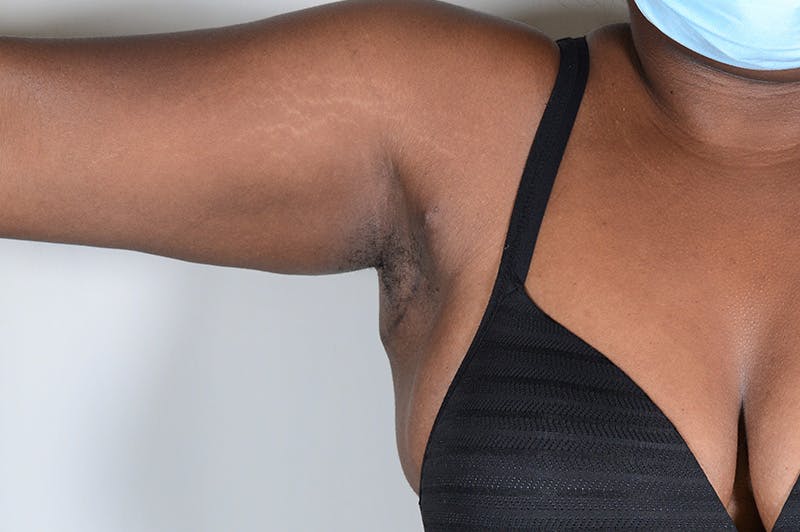 Axillary Breast Tissue Before & After Gallery - Patient 188969 - Image 3