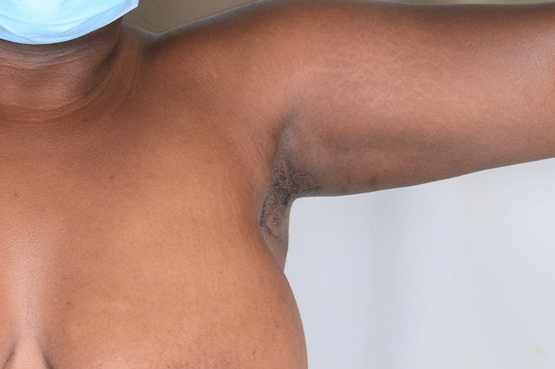 Axillary Breast Tissue Before & After Gallery - Patient 188969 - Image 6