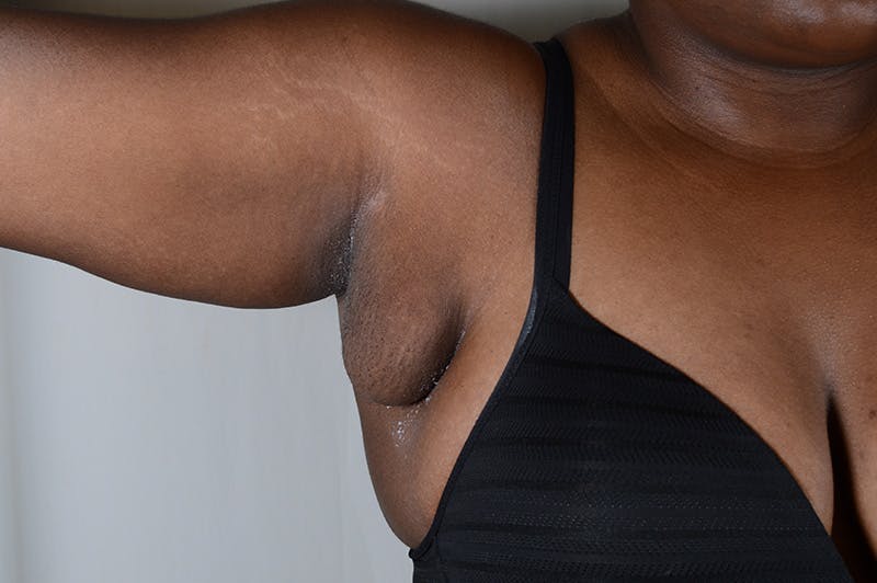 Axillary Breast Tissue Before & After Gallery - Patient 188969 - Image 4