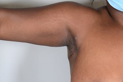 Axillary Breast Tissue Before & After Gallery - Patient 188969 - Image 2