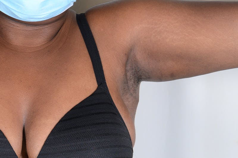 Axillary Breast Tissue Before & After Gallery - Patient 188969 - Image 8