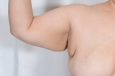 Axillary Breast Tissue Before & After Gallery - Patient 236751 - Image 1