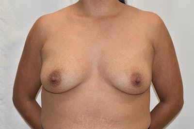 Breast Augmentation Before & After Gallery - Patient 297448 - Image 1