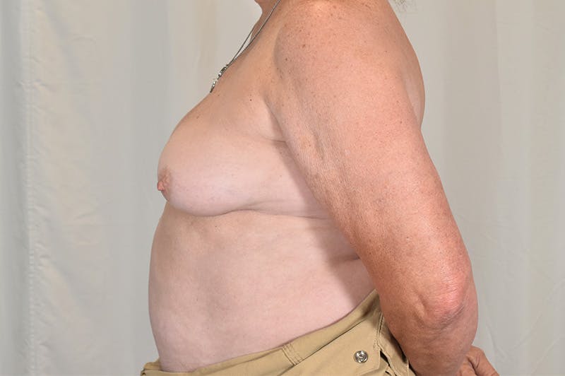Breast Implant Revision Before & After Gallery - Patient 350749 - Image 9