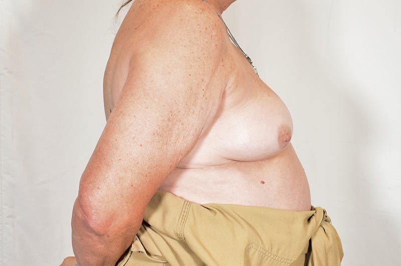 Breast Implant Revision Before & After Gallery - Patient 350749 - Image 5