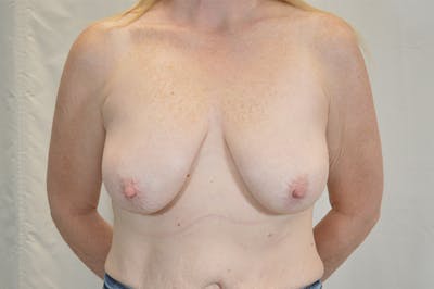 Breast Lift With Implant Before & After Gallery - Patient 393097 - Image 1