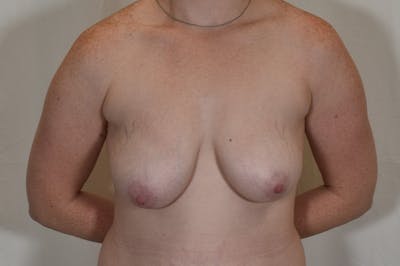 Breast Lift With Implant Before & After Gallery - Patient 104686 - Image 1