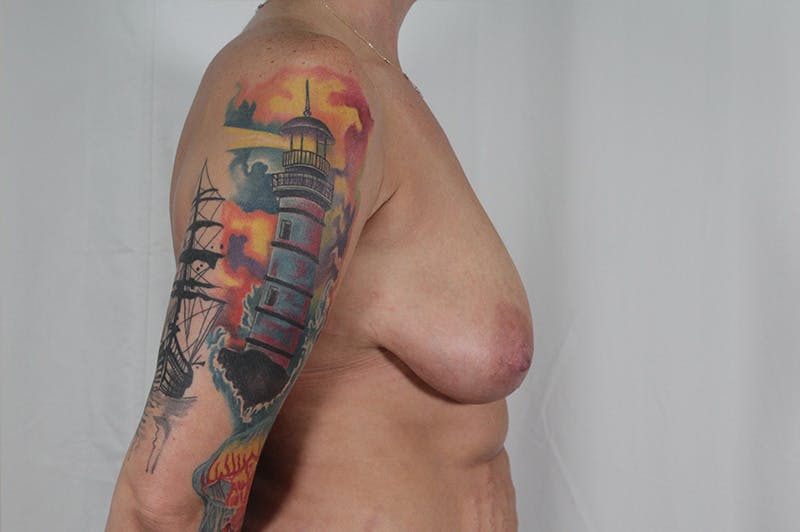 Breast Lift With Implant Before & After Gallery - Patient 139841 - Image 5