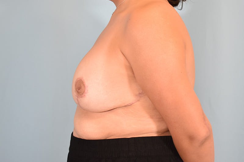 Breast Lift With Implant Before & After Gallery - Patient 254896 - Image 10