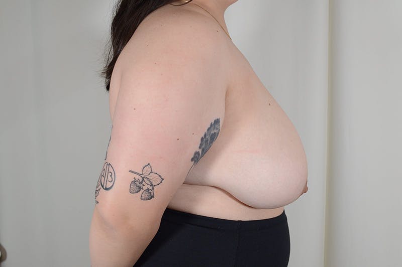 Breast Reduction Before & After Gallery - Patient 166633 - Image 5