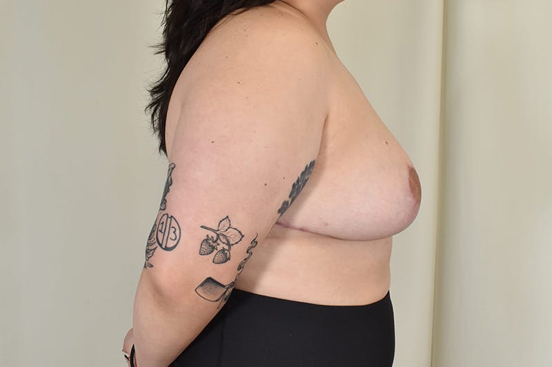 Breast Reduction Before & After Gallery - Patient 166633 - Image 6
