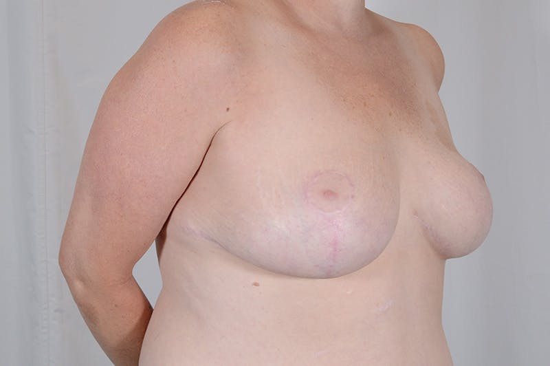 Breast Reduction Before & After Gallery - Patient 369133 - Image 4