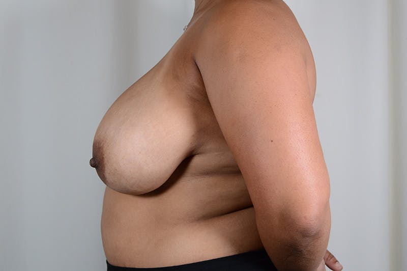 Breast Reduction Before & After Gallery - Patient 299763 - Image 9