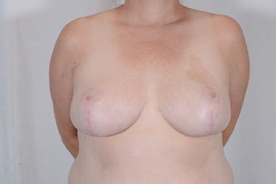 Breast Reduction Before & After Gallery - Patient 369133 - Image 2