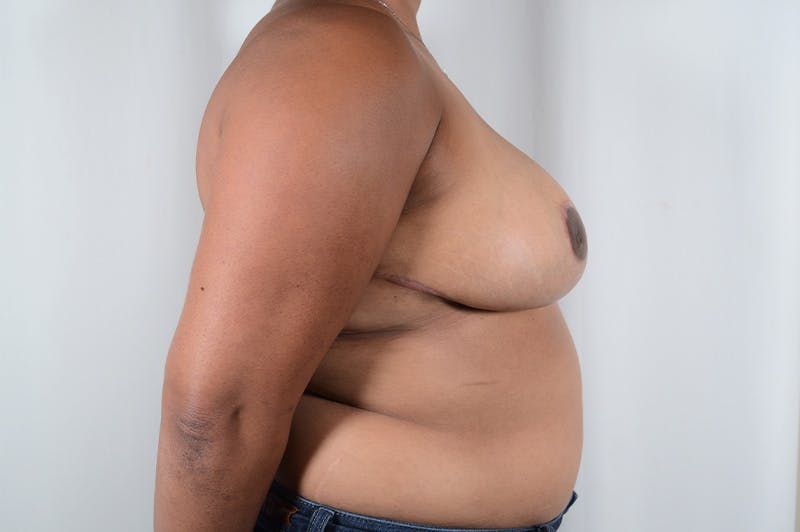 Breast Reduction Before & After Gallery - Patient 299763 - Image 6