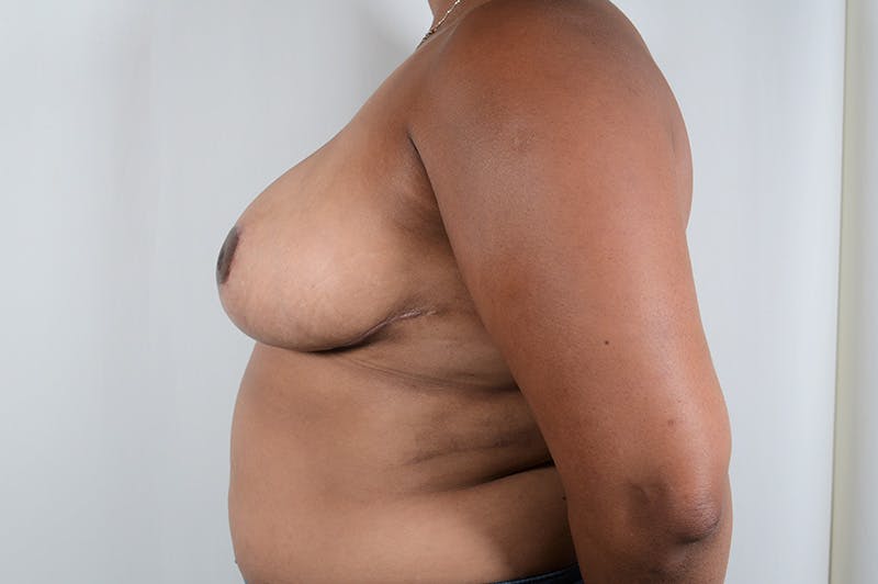 Breast Reduction Before & After Gallery - Patient 299763 - Image 10