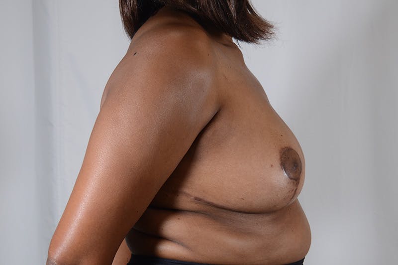 Breast Reduction Before & After Gallery - Patient 288403 - Image 6