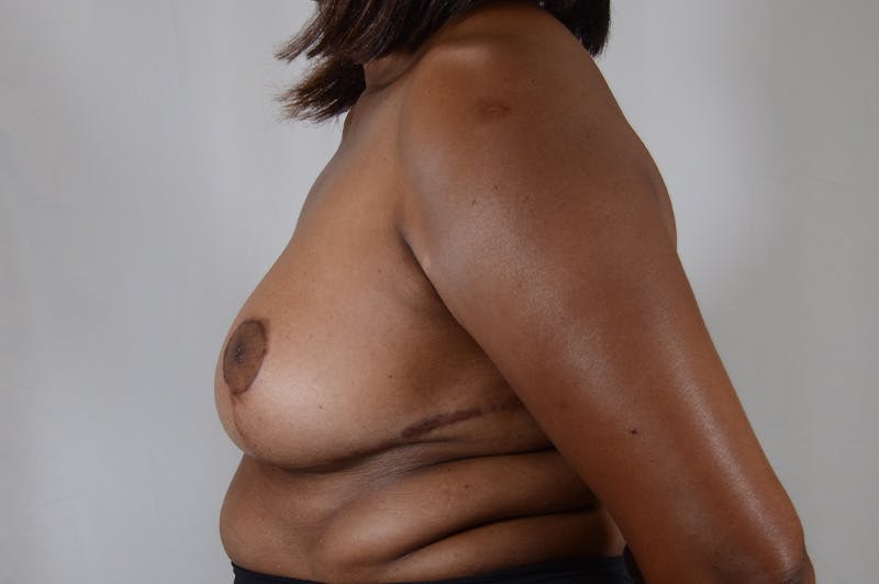 Breast Reduction Before & After Gallery - Patient 288403 - Image 10