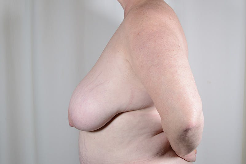 Breast Reduction Before & After Gallery - Patient 300102 - Image 9