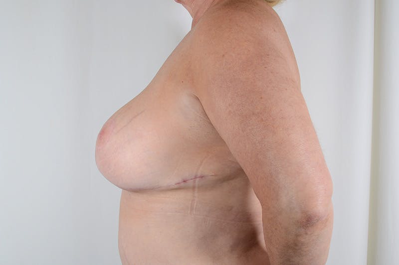 Breast Reduction Before & After Gallery - Patient 300102 - Image 10