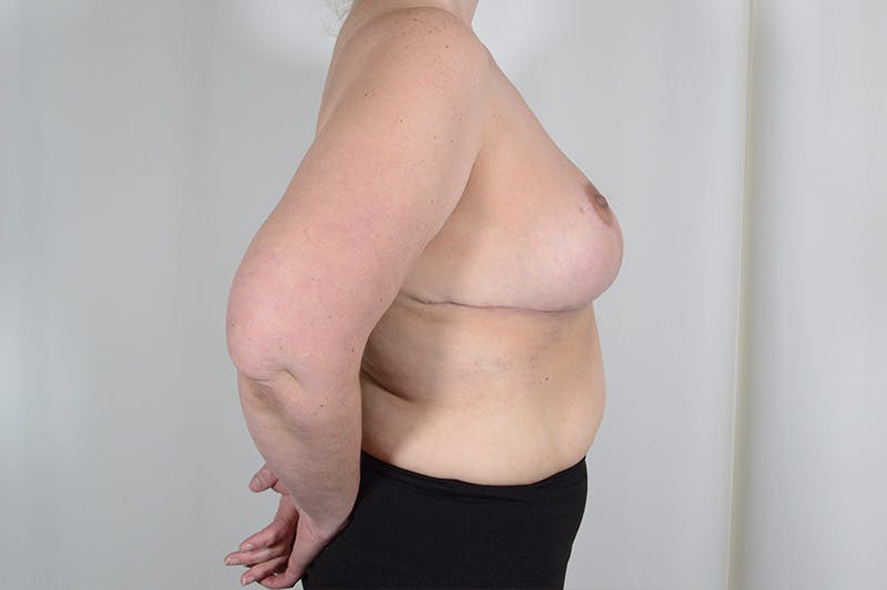 Breast Reduction Before & After Gallery - Patient 126050 - Image 10