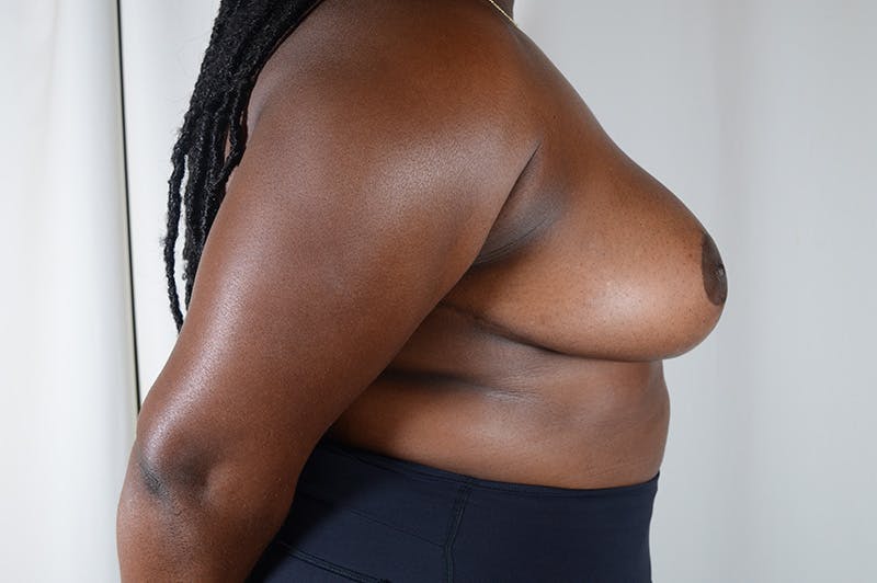 Breast Reduction Before & After Gallery - Patient 210802 - Image 6