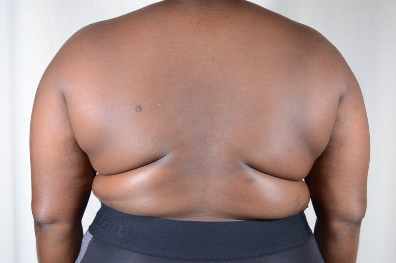 Breast Reduction Before & After Gallery - Patient 210802 - Image 9