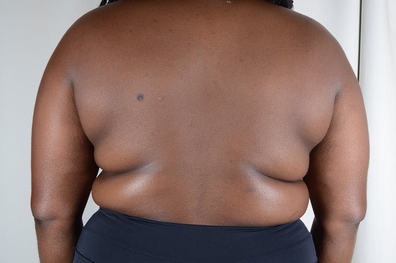 Breast Reduction Before & After Gallery - Patient 210802 - Image 10