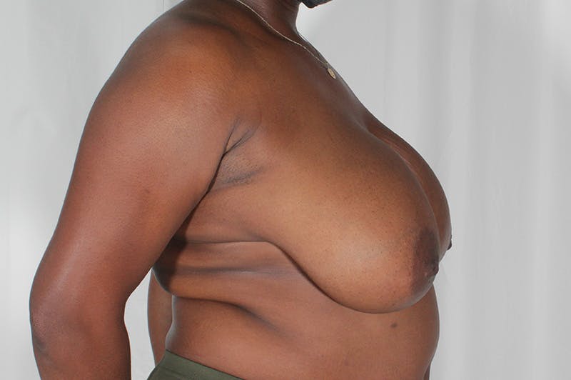 Breast Reduction Before & After Gallery - Patient 413689 - Image 7