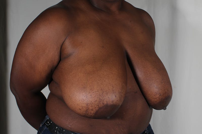 Breast Reduction Before & After Gallery - Patient 404942 - Image 3