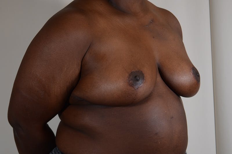 Breast Reduction Before & After Gallery - Patient 404942 - Image 4
