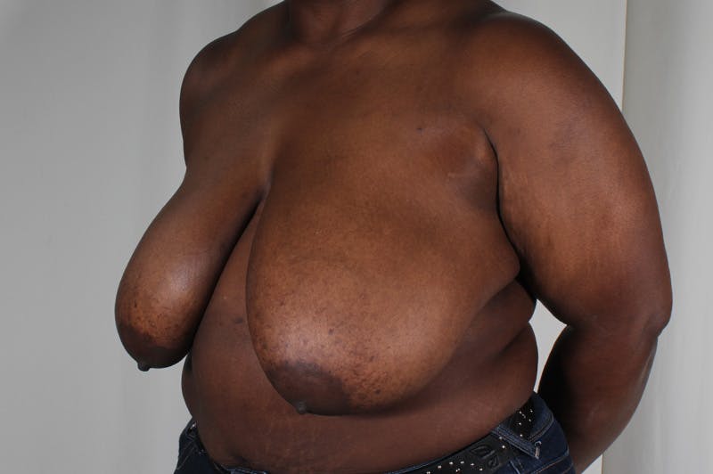 Breast Reduction Before & After Gallery - Patient 404942 - Image 5