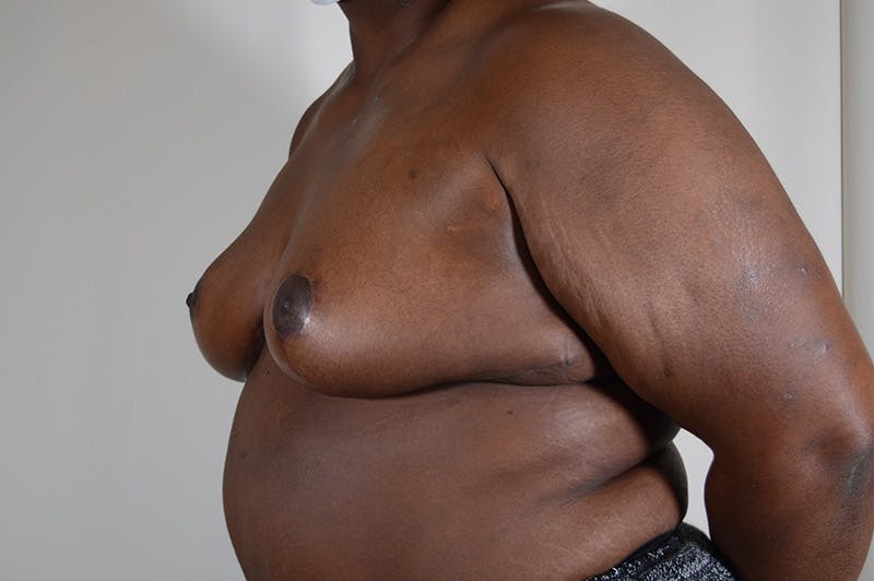 Breast Reduction Before & After Gallery - Patient 404942 - Image 6