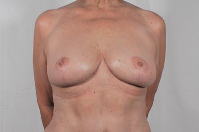 Mastopexy Before & After Gallery - Patient 994332 - Image 2