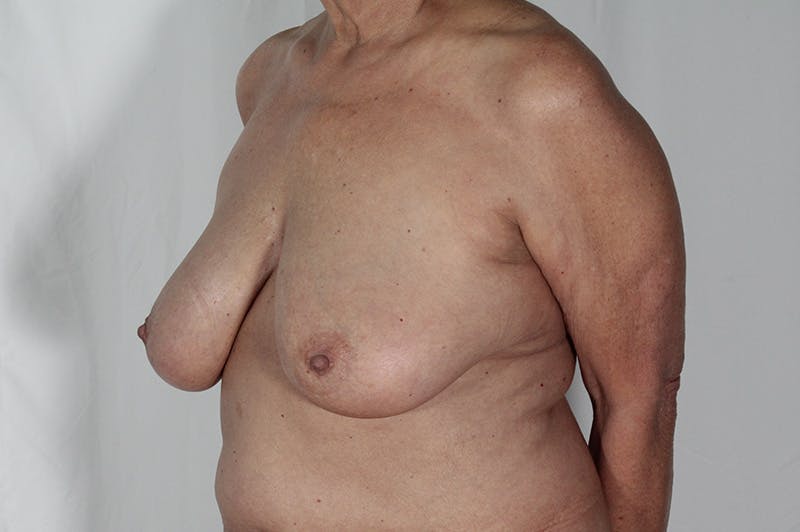 Mastopexy Before & After Gallery - Patient 994332 - Image 5