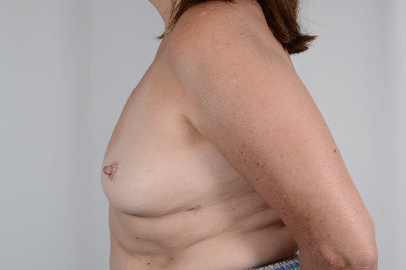 Explant Before & After Gallery - Patient 144976 - Image 10