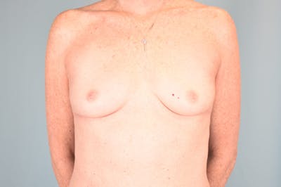Explant Before & After Gallery - Patient 193648 - Image 2
