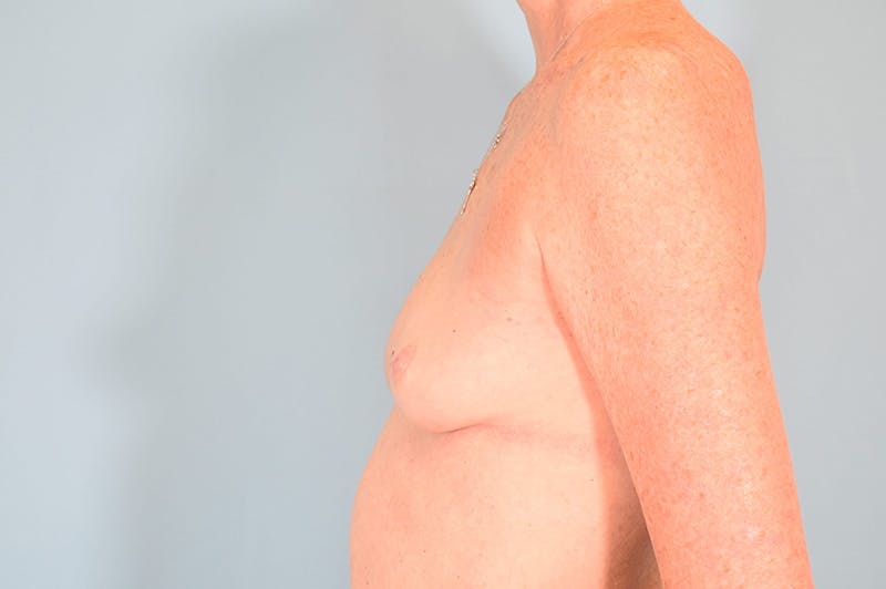 Explant Before & After Gallery - Patient 193648 - Image 10