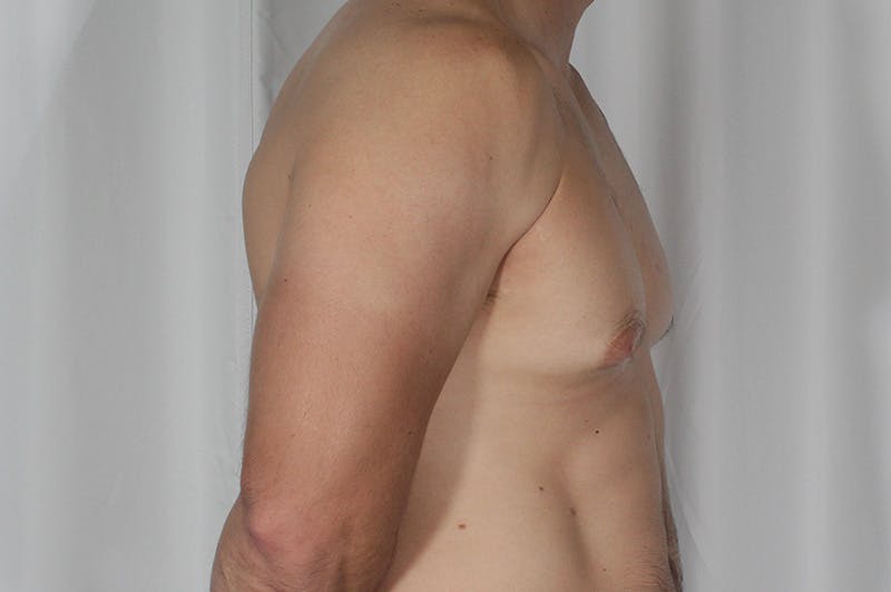 Gynecomastia Before & After Gallery - Patient 324633 - Image 5