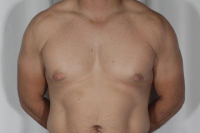 Gynecomastia Before & After Gallery - Patient 324633 - Image 1