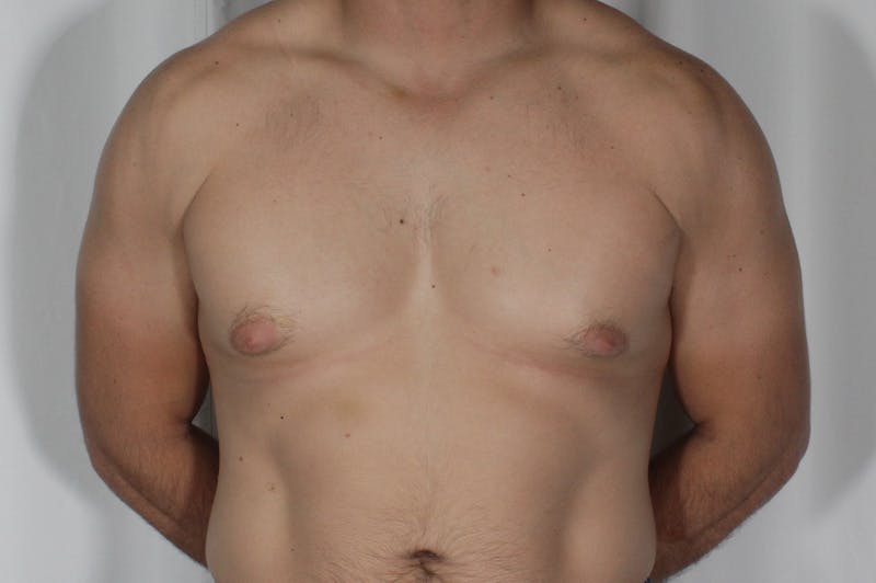 Gynecomastia Before & After Gallery - Patient 324633 - Image 1
