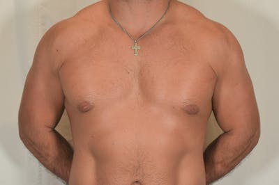 Gynecomastia Before & After Gallery - Patient 324633 - Image 2