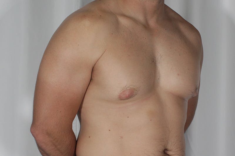 Gynecomastia Before & After Gallery - Patient 324633 - Image 3
