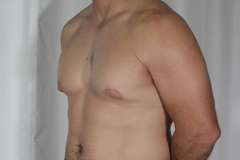 Gynecomastia Before & After Gallery - Patient 324633 - Image 7