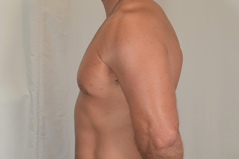 Gynecomastia Before & After Gallery - Patient 324633 - Image 10