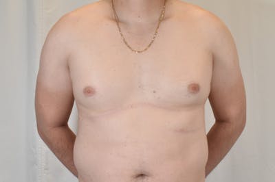Gynecomastia Before & After Gallery - Patient 265097 - Image 1