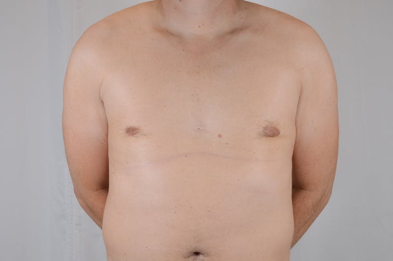 Gynecomastia Before & After Gallery - Patient 265097 - Image 2