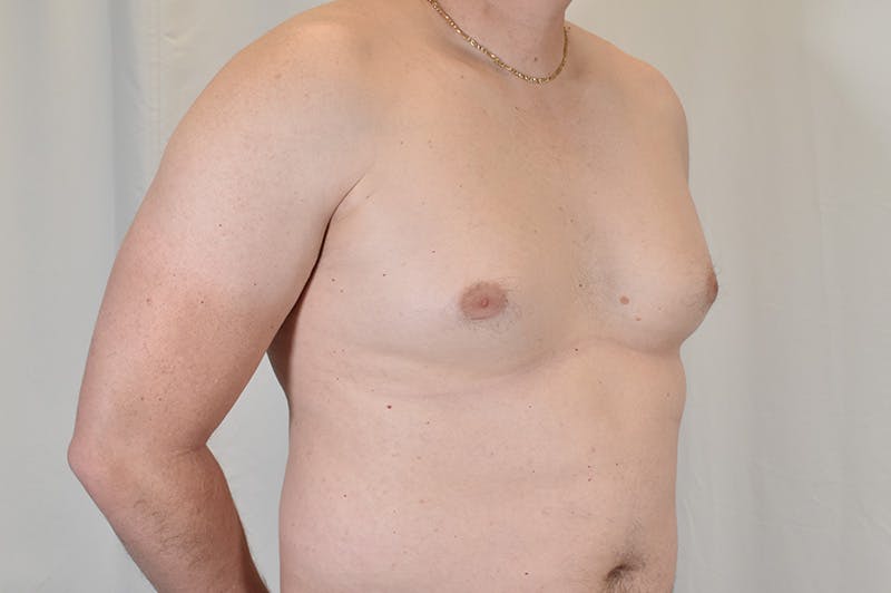 Gynecomastia Before & After Gallery - Patient 265097 - Image 3