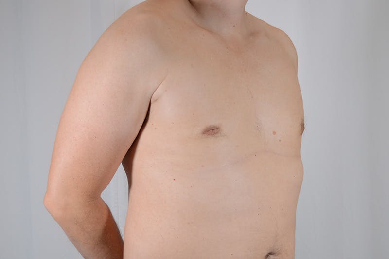 Gynecomastia Before & After Gallery - Patient 265097 - Image 4
