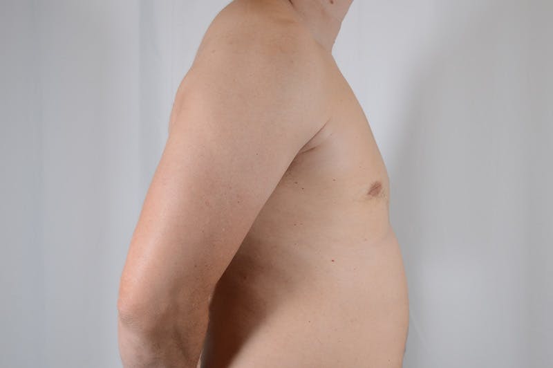 Gynecomastia Before & After Gallery - Patient 265097 - Image 6